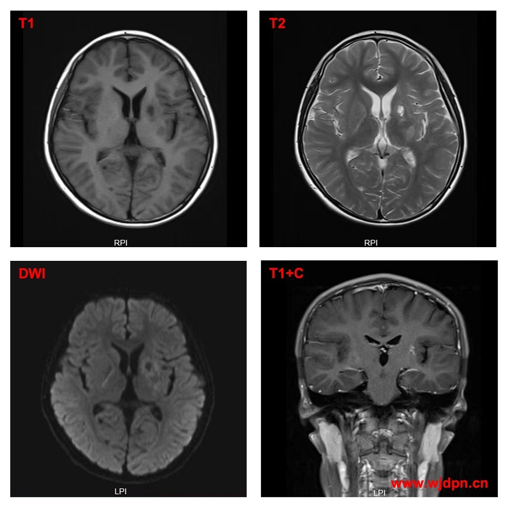 中枢神经系统生殖细胞肿瘤MRI表现 儿童癫痫长程管理